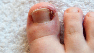 ingrown toenail removal doctor